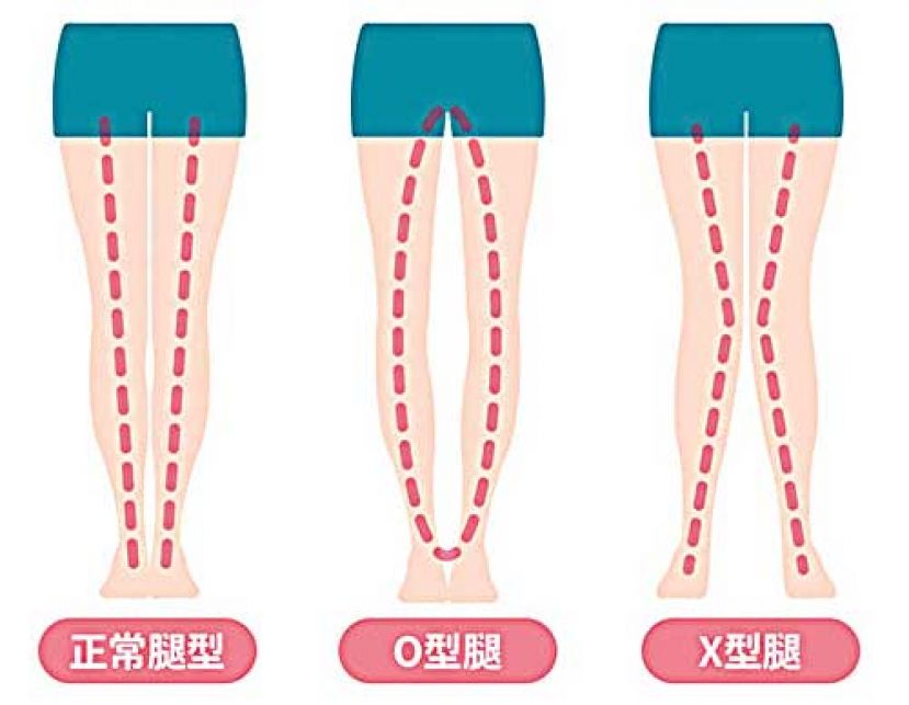 孩子O型或X型腿怎么办？ 一些症状当心是疾病