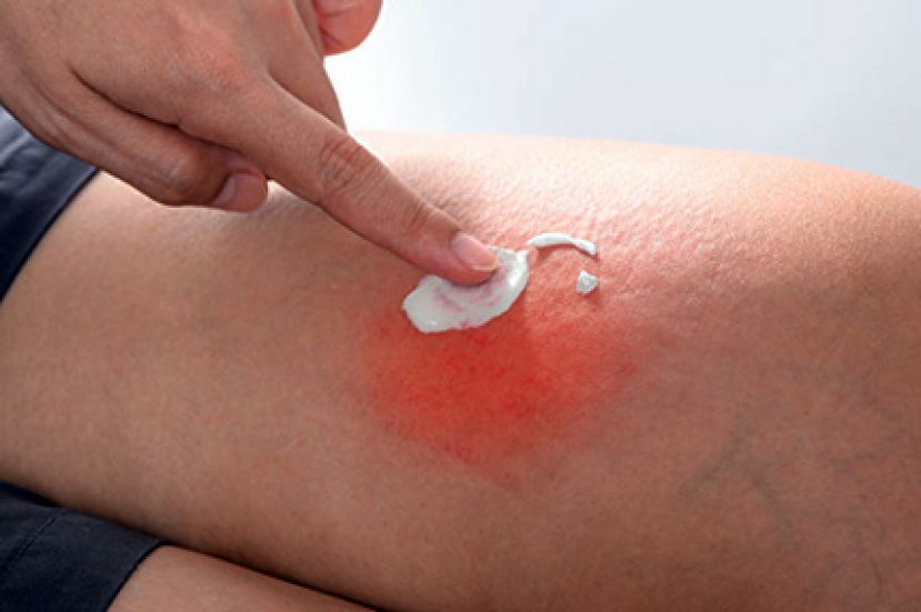 蚊子叮咬越抓越痒 六种方法快速止痒