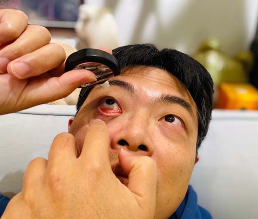 ●眼睛向上看，轻拉下眼睑，将眼药水滴入下眼睑内，才是正确用药方式。