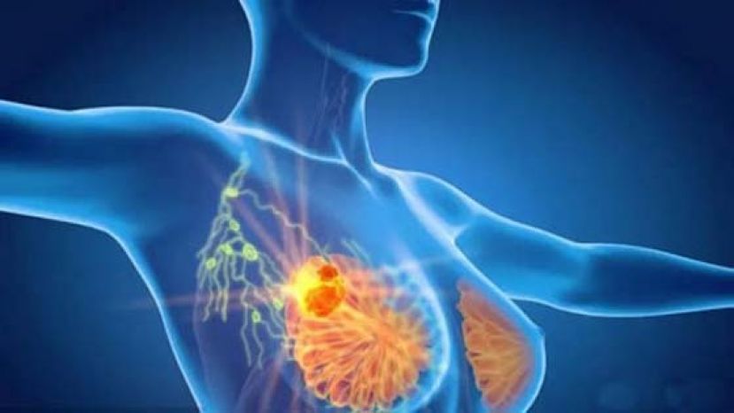 乳癌术中直接放疗　一次治愈早期乳癌