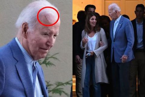 82岁拜登癌症治疗后首露面　额头明显手术刀疤需搀扶