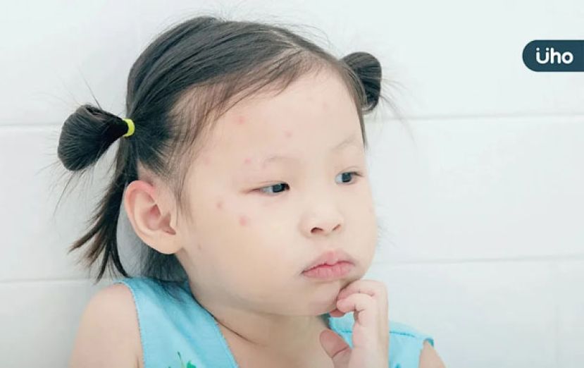 水痘症状会蔓延全身　医警告成人更严重恐致脑炎