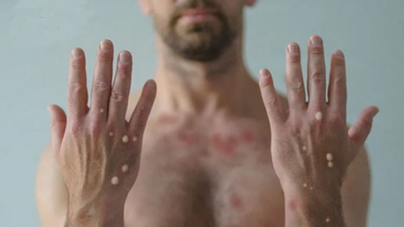 身上长疹子是猴痘吗？ 医揭 &ldquo;症状发作顺序&rdquo; 若合并1关键恐已感染