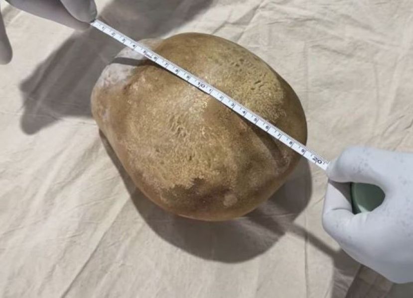  结石长约17厘米。