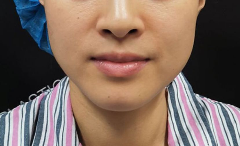 不再松垂垮？ 熟女&ldquo;全层次拉皮&rdquo;找回自信唤醒自然美