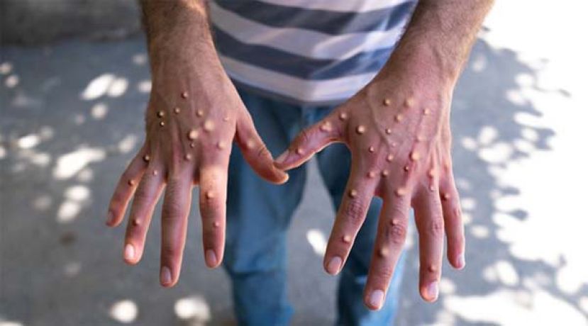 英格兰发现新M痘病毒株，感染者近期到访亚洲。