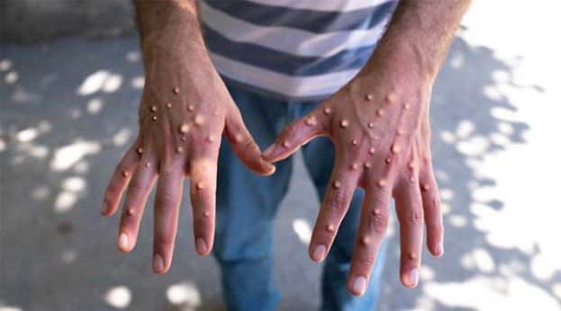 英格兰发现新M痘病毒株，感染者近期到访亚洲。