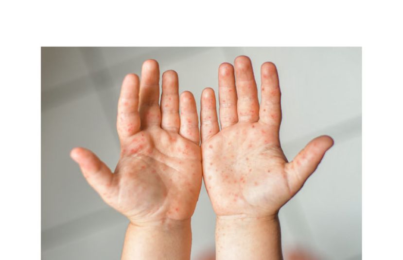 截至上周录得近10万　大马手足口症激增266%