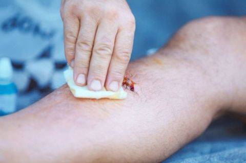 皮肤伤口用生理食盐水清洁　出现3征兆恐严重感染