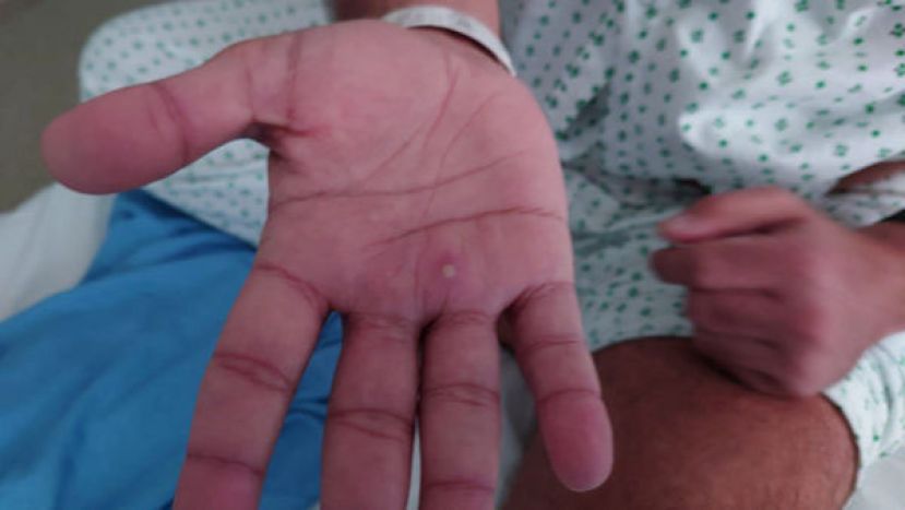 世界卫生组织宣布将猴痘改名为mpox，避免污名化。