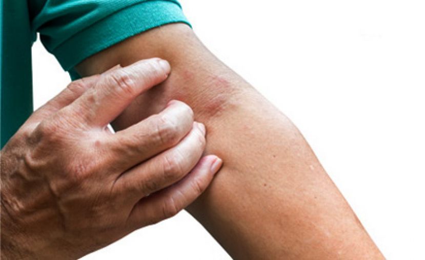 异位性皮肤炎好痒 四步骤急救干痒肌