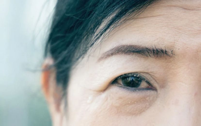 黄斑部病变导致眼出血　血管瘤增生视力仅剩0.5