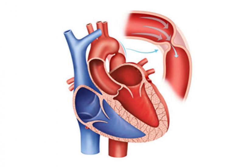 心血管狭窄是无声杀手 夜间盗汗别轻忽