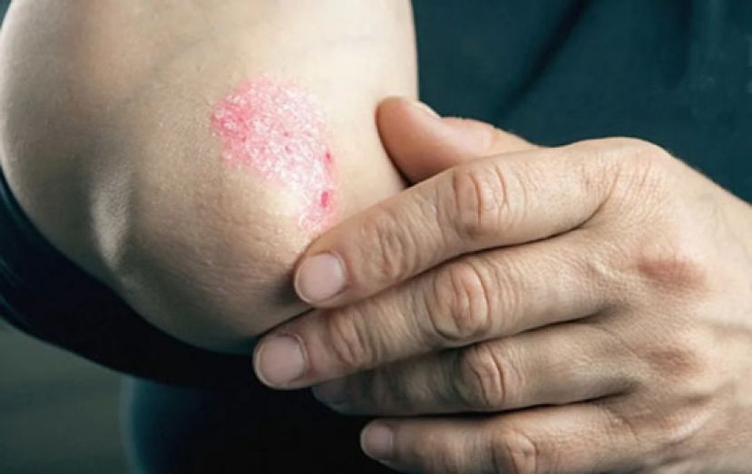 皮肤红肿脱屑&hellip;恐全身发炎征兆　医警告：肠癌风险逾常人1倍