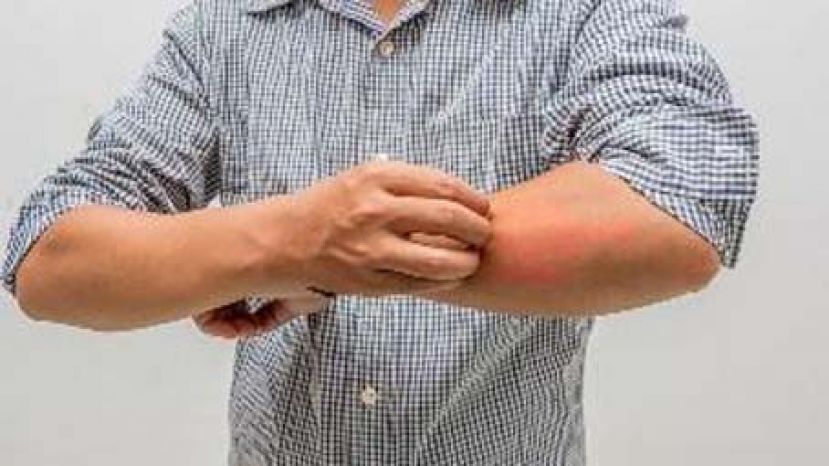 偏方治干癣成移动雪人　新药助清病灶