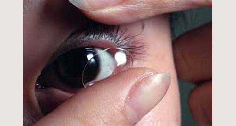 少戴隐形眼镜防新冠肺炎？　眼科医师揭隐眼注意事项