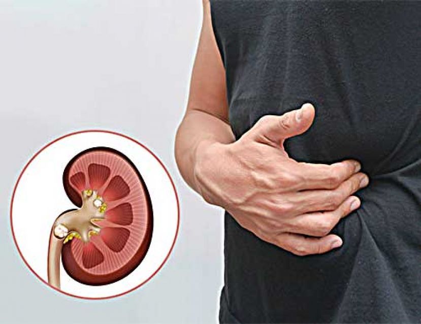 腰痛可能是结石在体内？ 教你分辨腰痛和结石痛