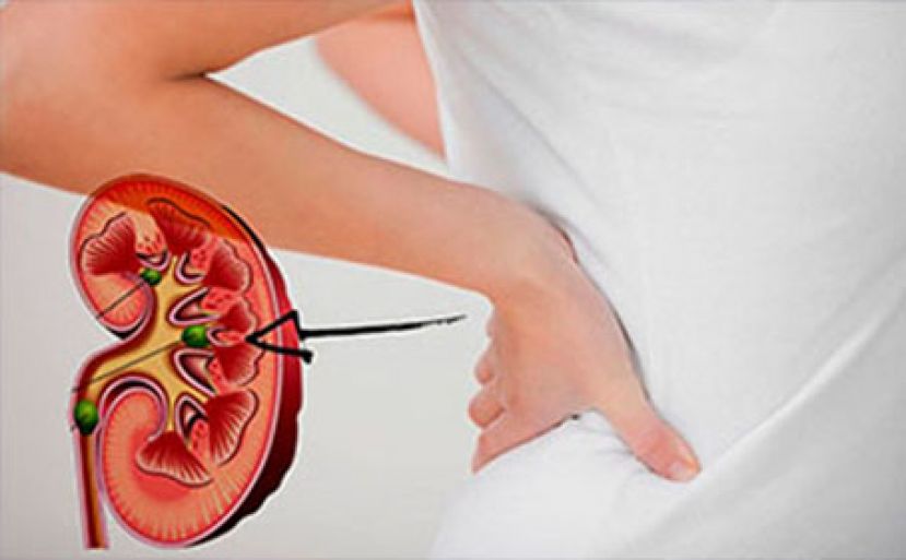 &ldquo;感染性肾结石&rdquo; 好发女性　1手术避免反复结石