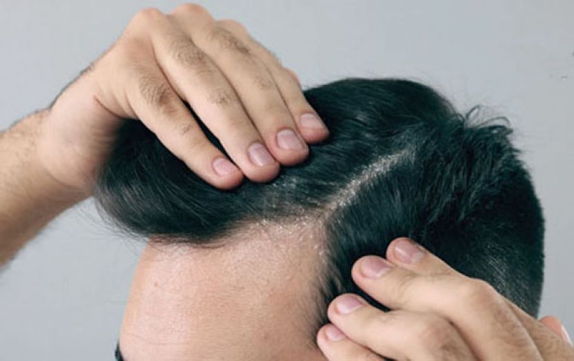 是干癣或脂漏性皮肤炎？ 台大医揭1关键差异