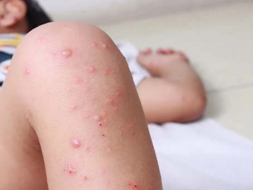 麻疹症状有哪些？  出现1症状与感冒最不同