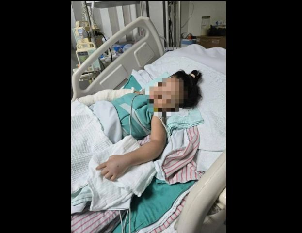 2岁女童因保姆疏忽 身体35%面积遭开水烫伤