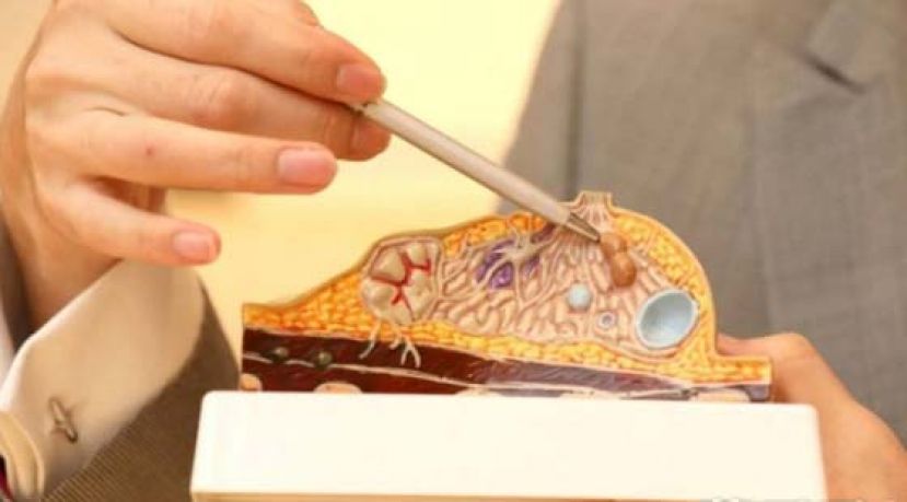 摸到乳房硬块勿恐慌 可属良性水囊或乳腺纤维瘤