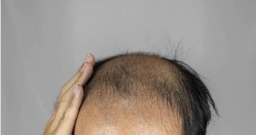 研究指，年轻时就有掉发困扰的男性，未来罹患摄护腺癌的风险反而显着降低近3成。