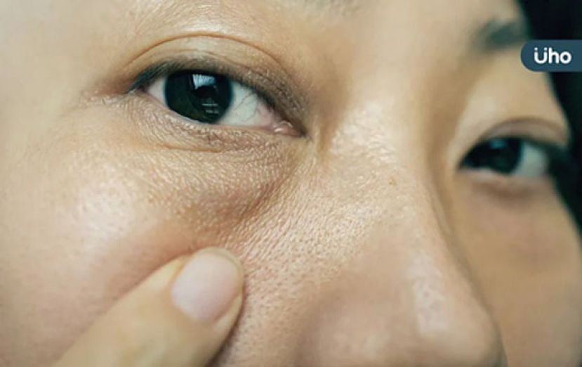 紫外线让眼皮老化下垂　6招减缓眼周老化
