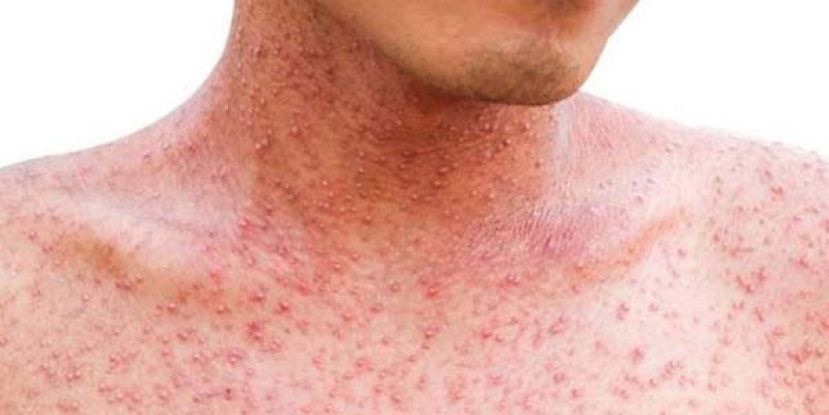 世卫：疫苗接种率不足，全球麻疹病例去年激增。