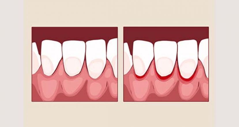 牙龈发炎8大原因一定要知道
