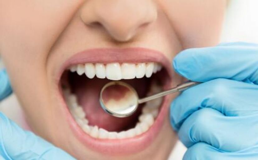 灼口综合症症状似热气 更年期女性较常见