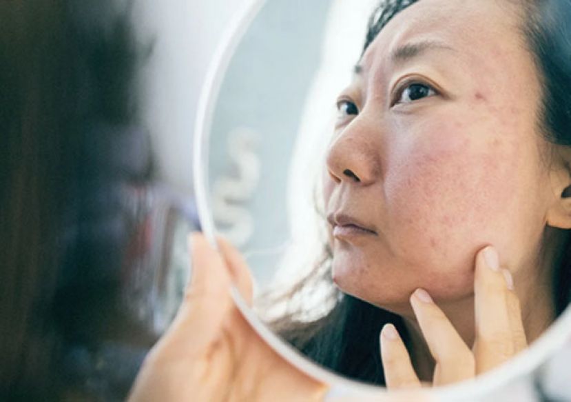 玫瑰斑复发怎么办？皮肤医教你揪诱发元凶