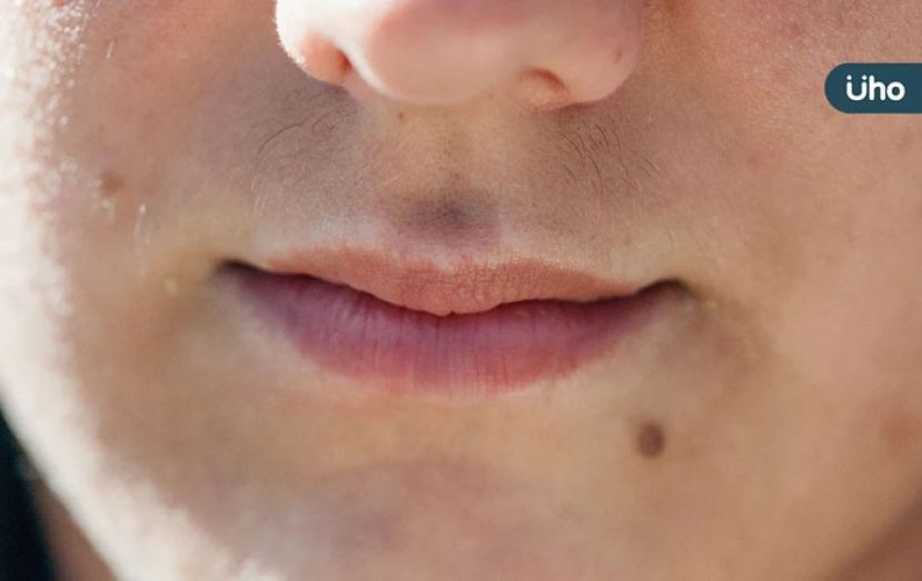 嘴唇黑点竟是癌变警讯？  医揪 &ldquo;黑斑息肉症候群&rdquo; 恐致肠癌乳癌