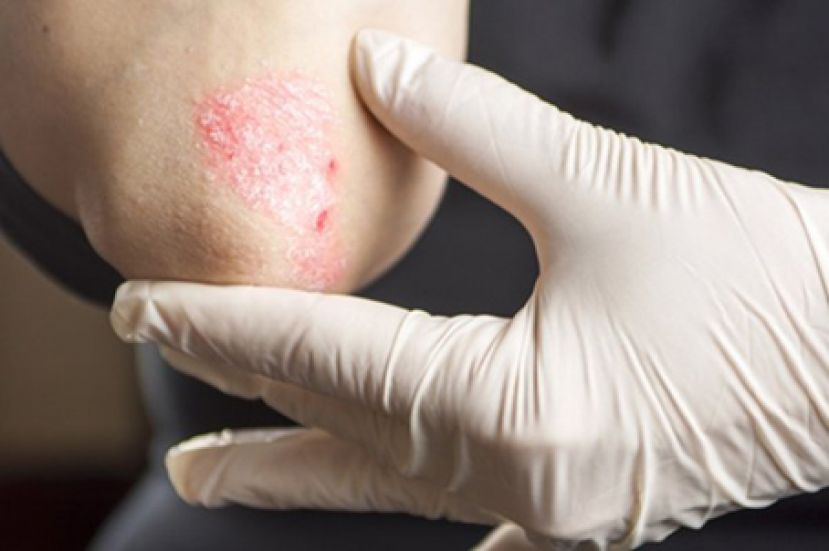 化&ldquo;癣&rdquo;为夷！长效生物制剂助他找回自信　防疫期用药更稳定