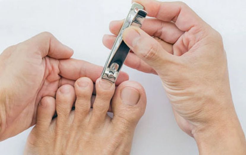 甲沟炎会自己好吗？医教正确剪指甲技巧：剪平不剪短