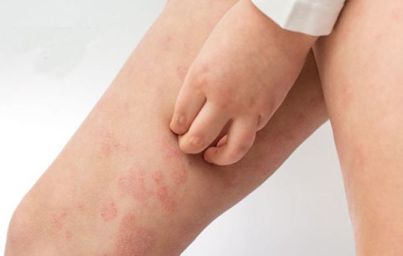 皮肤反覆湿疹内服外用都治不好　竟是 &ldquo;恶性皮肤T细胞淋巴瘤&rdquo;