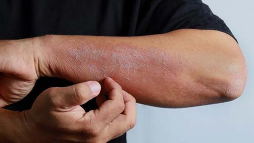 疫情期间干癣如何控制？生物制剂助化 &ldquo;癣&rdquo; 为夷！