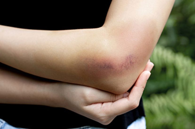 ２种方法缓解瘀青