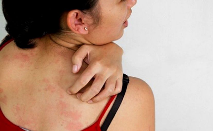 用姜泡醋治汗斑恐致皮肤炎