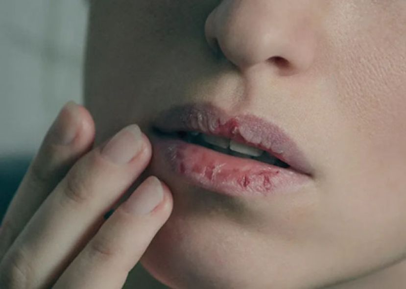 嘴唇干裂2原因竟跟体质有关？　中医：多吃黄色食物调理脾胃