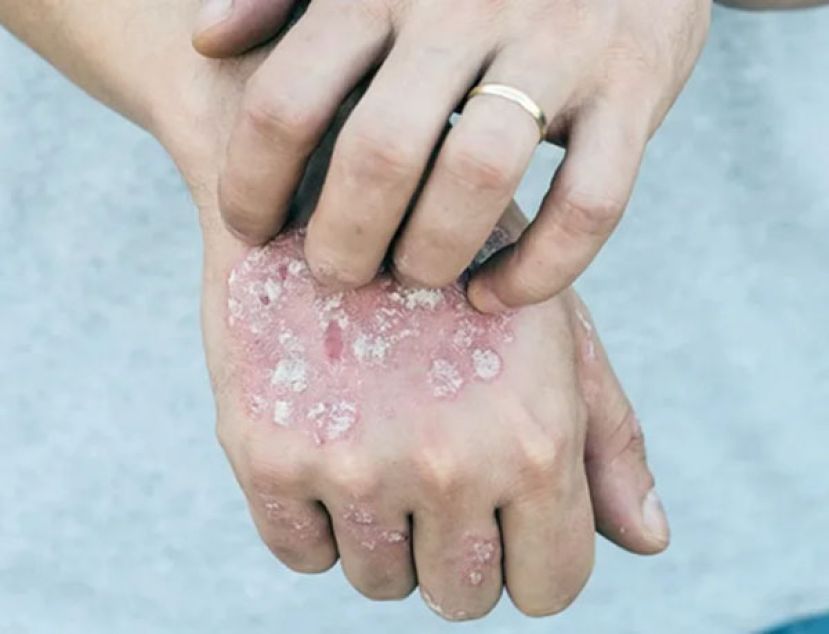干癣病灶清零不是梦　医曝1招超有效