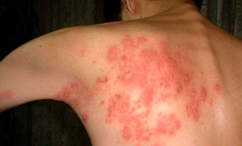 水痘病毒伺机攻击神经系统 或有生蛇风险