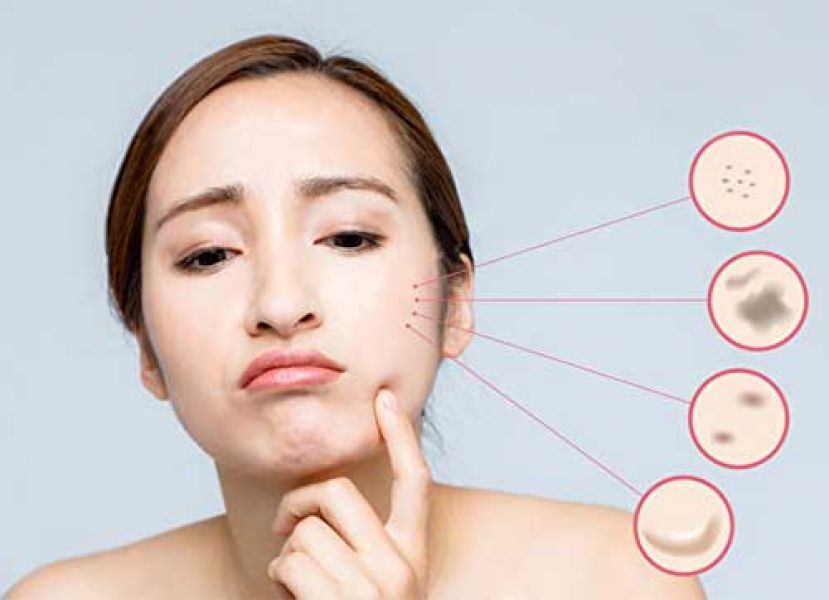 脸上斑点常见有4种 预防长斑是关键