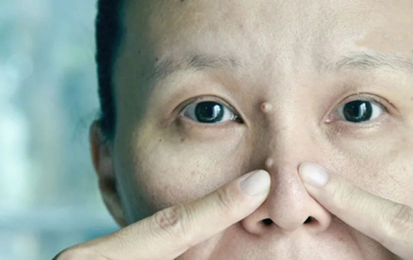 脸冒苔癣状凸起物　竟是病毒疣作祟