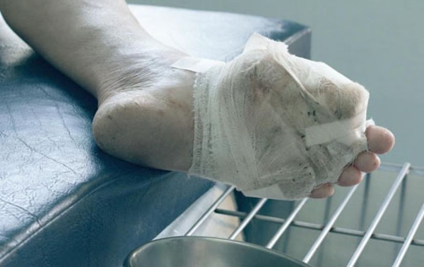 糖尿病足部溃伤严重恐截肢