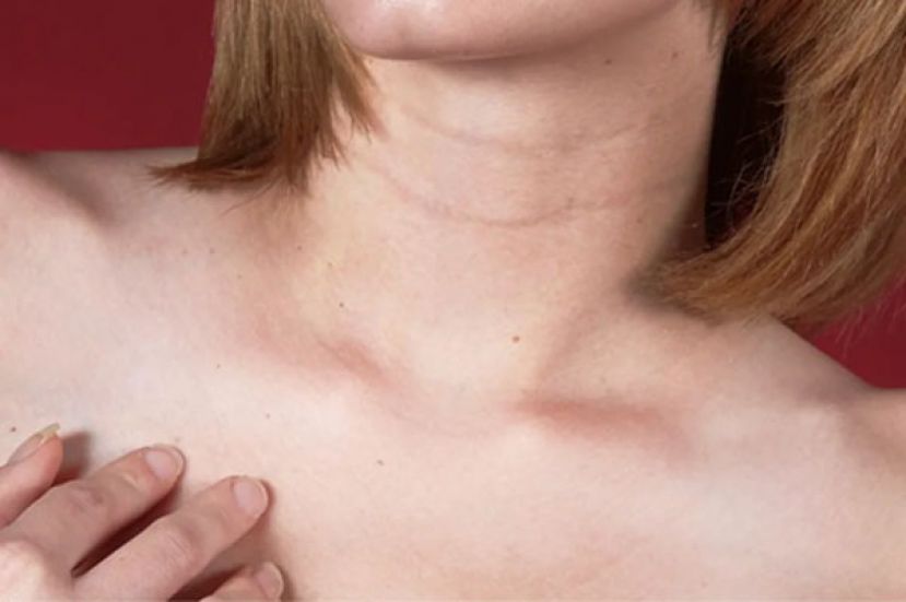 颈纹形成的原因分为先天与后天，现代人时常低头滑手机，恐导致颈部受到挤压而加速纹路产生。