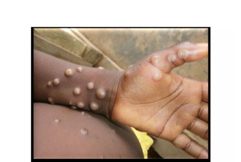 大马新增一宗M痘病例　34岁本地男子曾出国