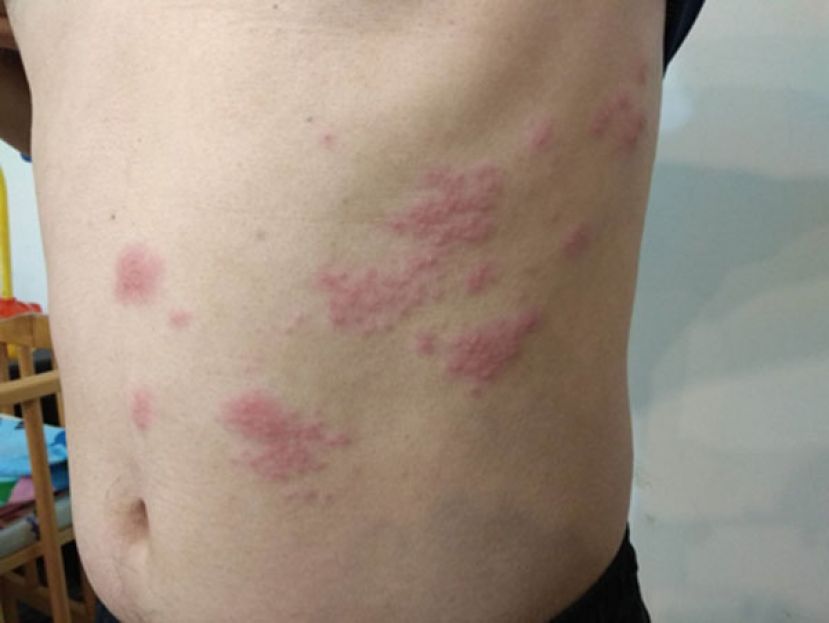 压力大 &ldquo;皮蛇&rdquo; 缠身　医揭这些族群患带状疱疹飙升风险