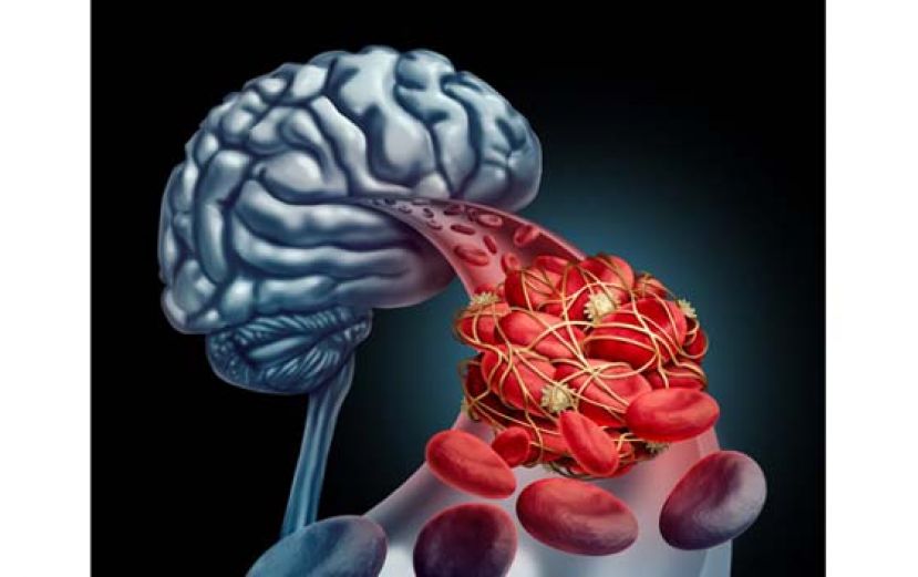 脑中风跟心房颤动有关？　心律监测预防二度中风