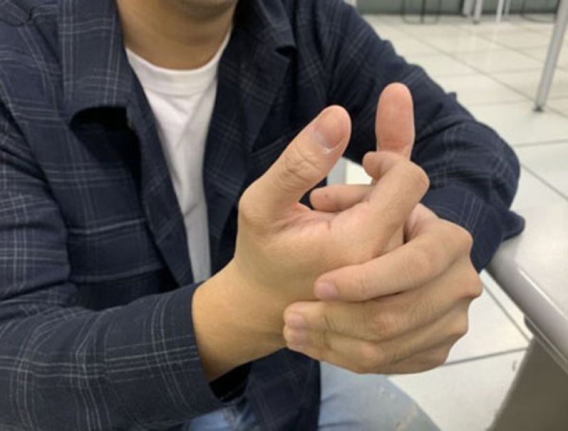折手指不只关节变粗　指部厚皮症好发年轻男性